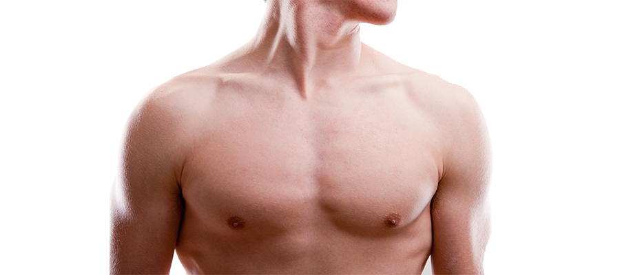 Gynecomastia